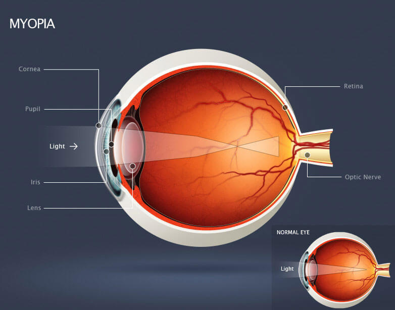 Myopia vs Normal Diagram